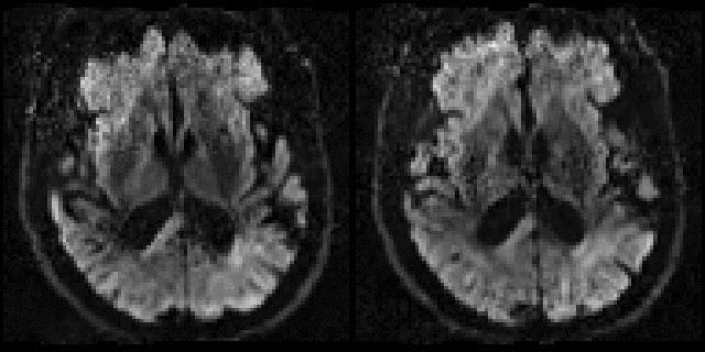 Example of data with and without outlier-replacement.