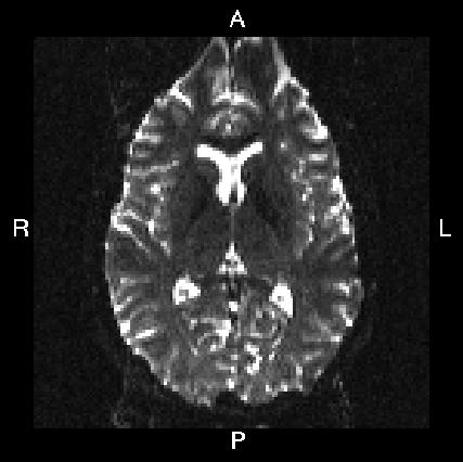 P->A SE-EPI image