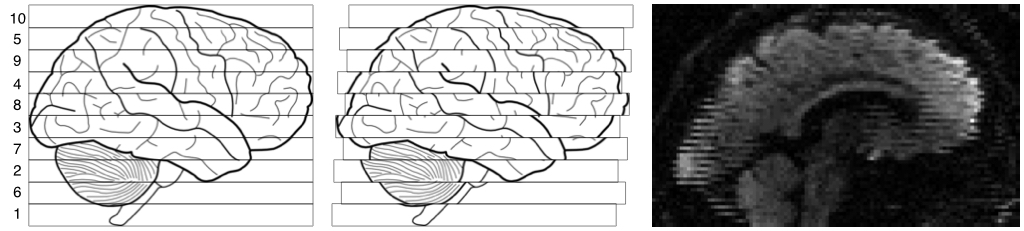 Explanation of zig-zag pattern from intra-volume movement.