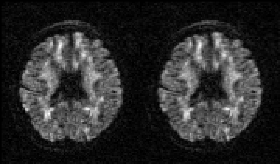 DWI images before and after EC-correction