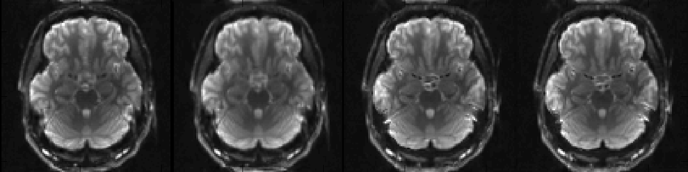 EPI images acquired with different PE-directions after correction