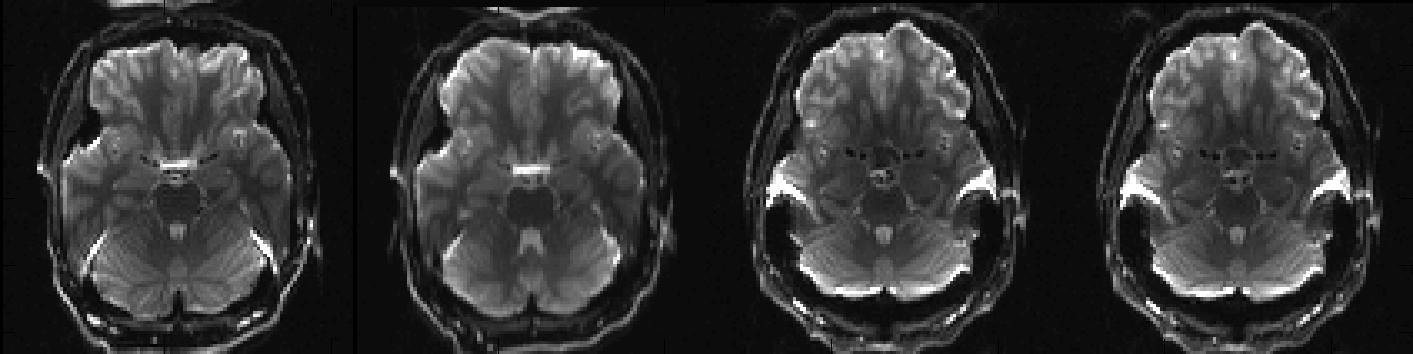 EPI images acquired with different PE-directions before correction