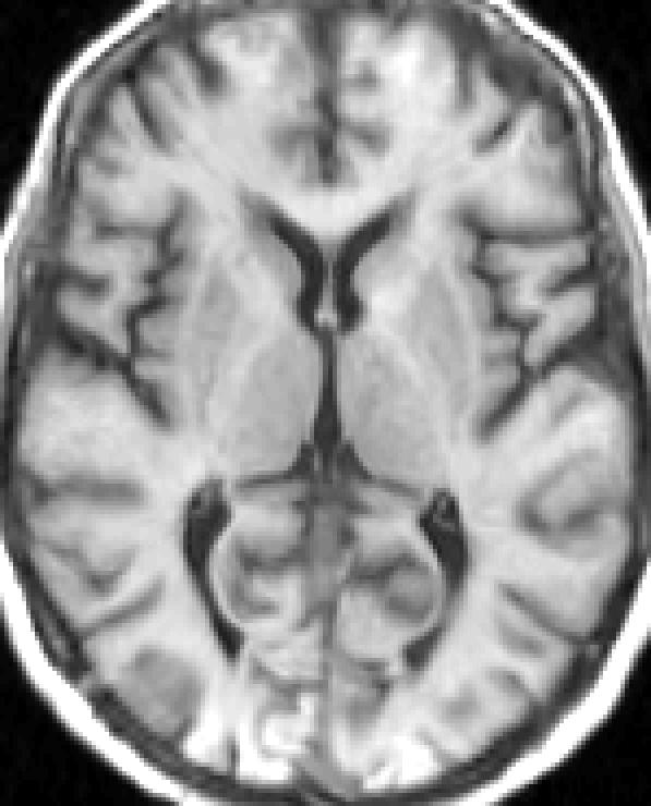 warped image medium regularisation