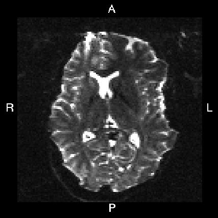 L->R SE-EPI image