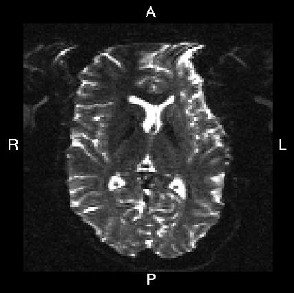 R->L SE-EPI image